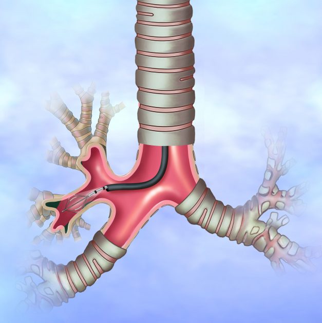 การส่องกล้องหลอดลม (Bronchoscopy)