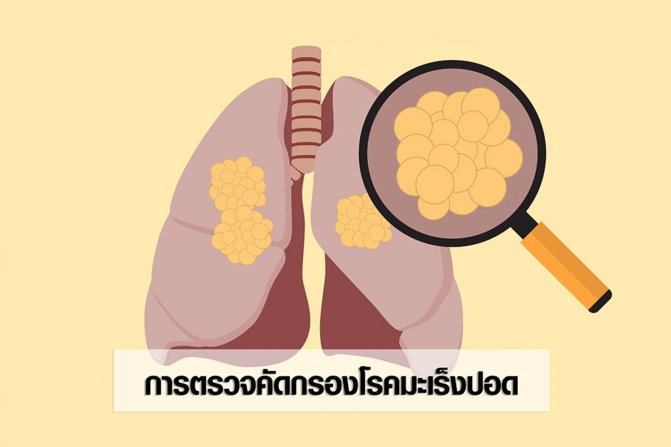 การตรวจคัดกรองโรคมะเร็งปอด Lung Cancer Screening