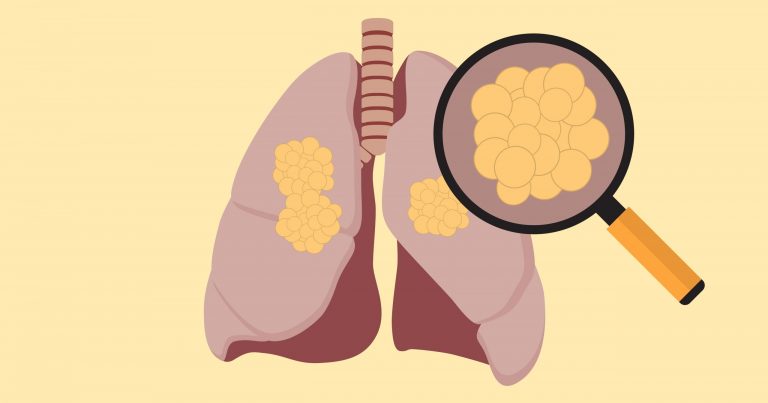 การตรวจคัดกรองโรคมะเร็งปอด (Lung Cancer Screening)