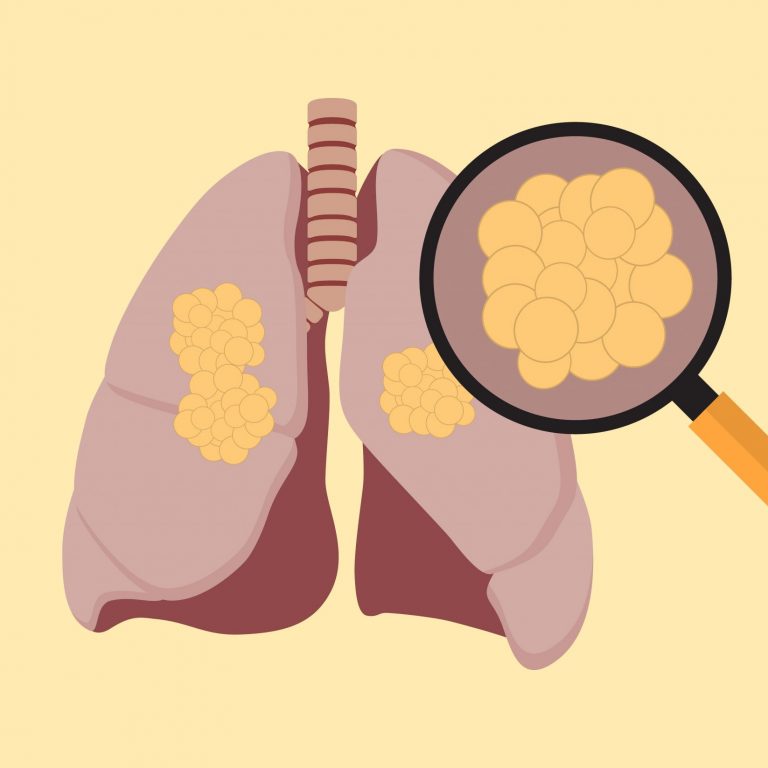 การตรวจคัดกรองโรคมะเร็งปอด (Lung Cancer Screening)