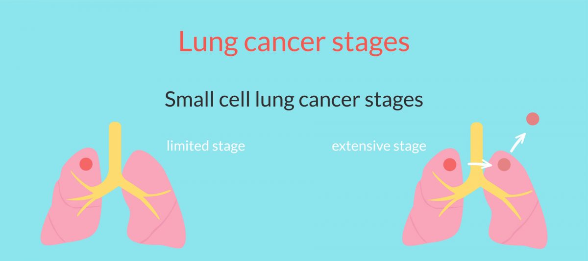 Small cell lung cancer