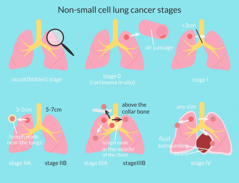 Non-small cell lung cancer